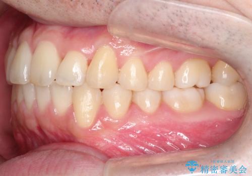 【クリア装置】前歯の凸凹を綺麗にしたいの治療後