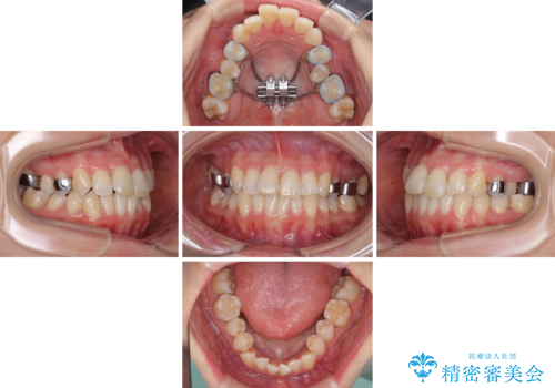 急速拡大装置で奥歯の咬み合わせを改善　インビザラインによる矯正治療の治療中