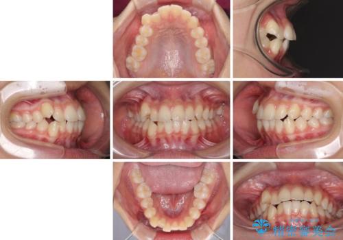 気がつくと口が開いてしまう　閉じにくい口元改善の抜歯矯正の治療前
