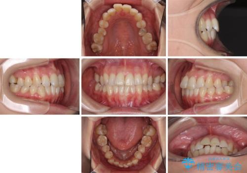 急速拡大装置で奥歯の咬み合わせを改善　インビザラインによる矯正治療の治療前