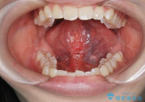 [ 舌小帯の形成 ]  滑舌が悪いと言われる、話しづらいの症例 治療後