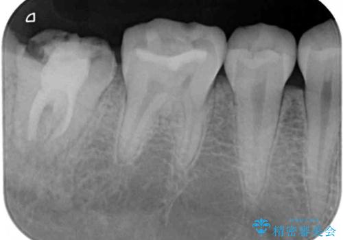 クラウンがすぐに外れてしまう　歯冠長延長術を用いた補綴治療の治療前