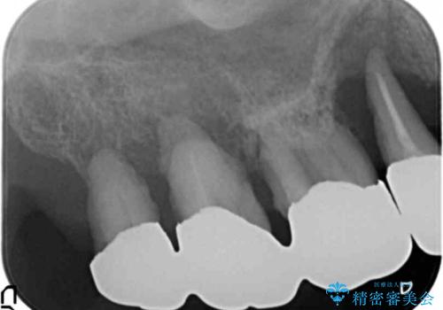 骨が薄く難しい上の奥歯のインプラント　50代男性の治療前
