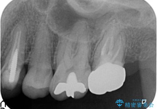 銀歯の下が虫歯になっている　セラミックインレー　30代女性の治療前