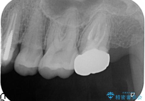 銀歯の下が虫歯になっている　セラミックインレー　30代女性の治療後