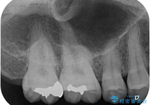 セラミックとゴールド　奥歯のむし歯治療の治療後
