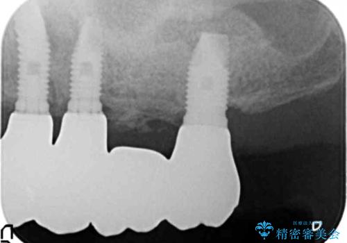 歯肉移植(FGG)による角化歯肉の獲得で長持ちするインプラントへ　50代男性の治療後