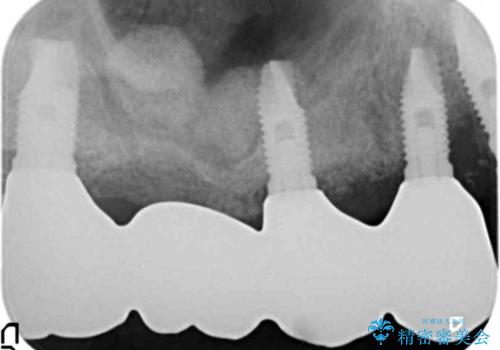 骨が薄く難しい上の奥歯のインプラント　50代男性の治療後