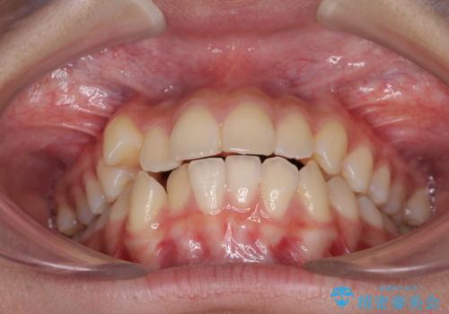 気がつくと口が開いてしまう　閉じにくい口元改善の抜歯矯正の治療前