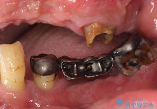 歯がぐらぐらで咬めない　奥歯のインプラント　50代男性の治療前