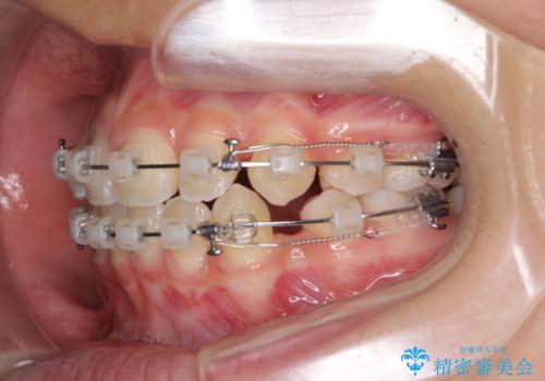 気がつくと口が開いてしまう　閉じにくい口元改善の抜歯矯正の治療中