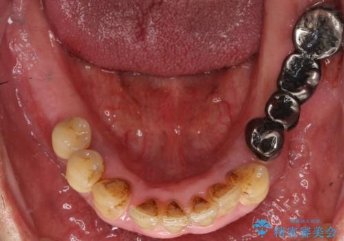 歯がぐらぐらで咬めない　奥歯のインプラント　50代男性の治療前
