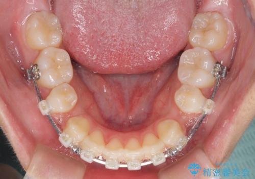 気がつくと口が開いてしまう　閉じにくい口元改善の抜歯矯正の治療中