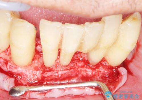 他院で抜歯と言われた歯　歯も神経も残したい　50代男性の治療中