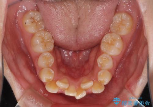 前歯が磨きにくい　目立たないワイヤー装置による矯正治療の治療前