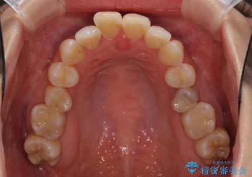 急速拡大装置で奥歯の咬み合わせを改善　インビザラインによる矯正治療の治療前