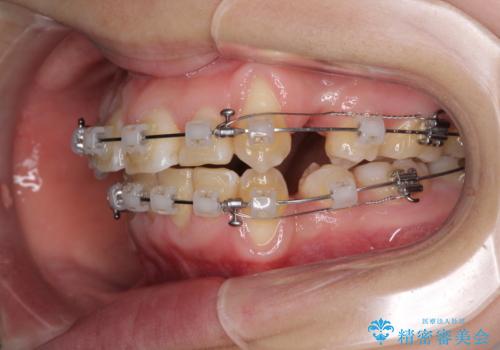 前歯が磨きにくい　目立たないワイヤー装置による矯正治療の治療中