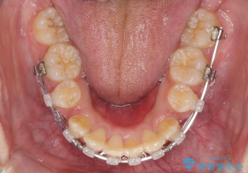 前歯が磨きにくい　目立たないワイヤー装置による矯正治療の治療中