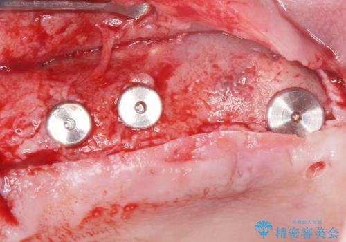 歯肉移植(FGG)による角化歯肉の獲得で長持ちするインプラントへ　50代男性の治療中