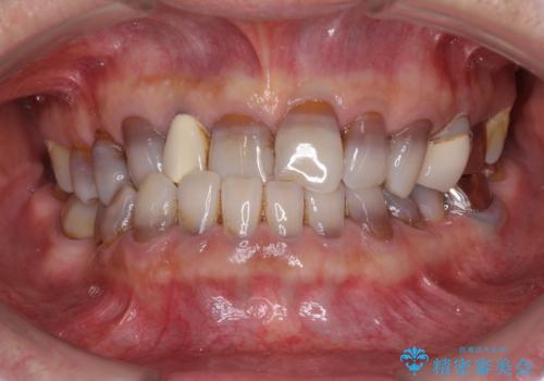 下の歯が前に出てしまう咬み合わせを治したい　インビザラインによる矯正治療の症例 治療前