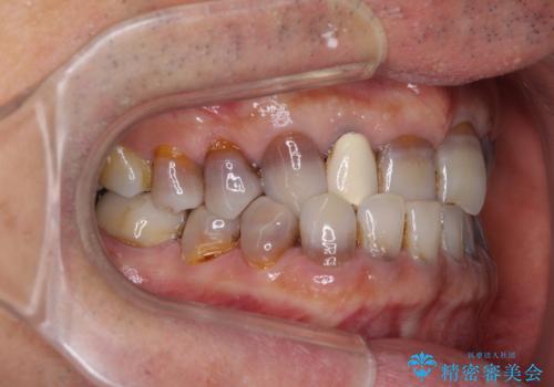 下の歯が前に出てしまう咬み合わせを治したい　インビザラインによる矯正治療の治療前
