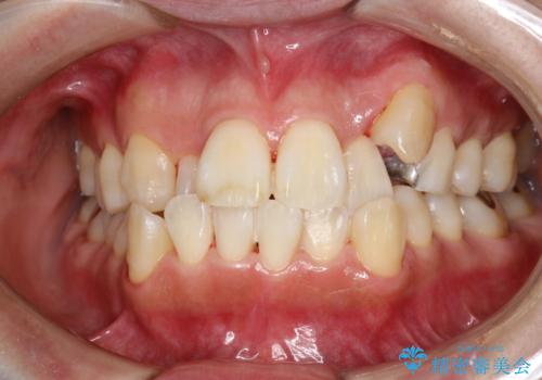 矯正治療が始まる前に歯のお掃除の治療後