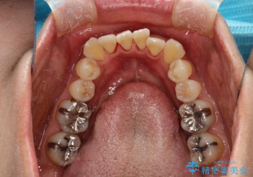 矯正治療が始まる前に歯のお掃除の治療後