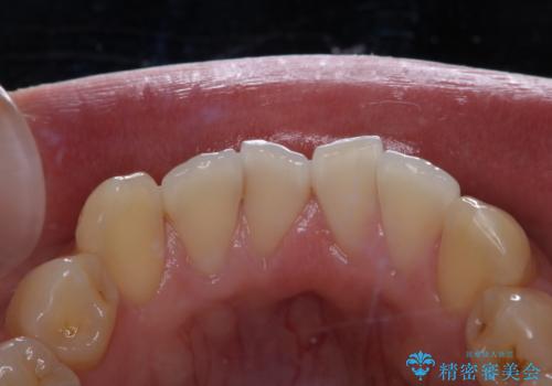 フロスが通せない　PMTCで本来の歯のすき間にの治療前