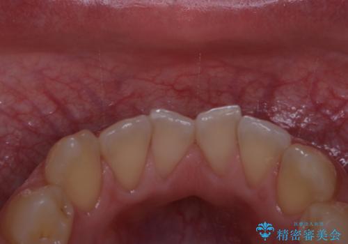 フロスが通せない　PMTCで本来の歯のすき間にの治療後