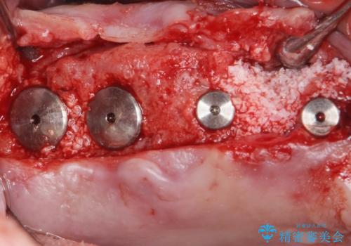 骨が薄く難しい上の奥歯のインプラント　50代男性の治療中
