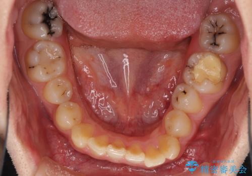 前歯のクロスバイトと抜歯が必要な奥歯の虫歯　インビザラインとインプラント治療の治療前