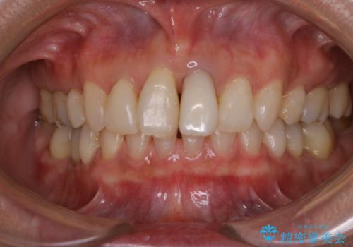 前歯の治療中にきれいに歯のクリーニングの治療後