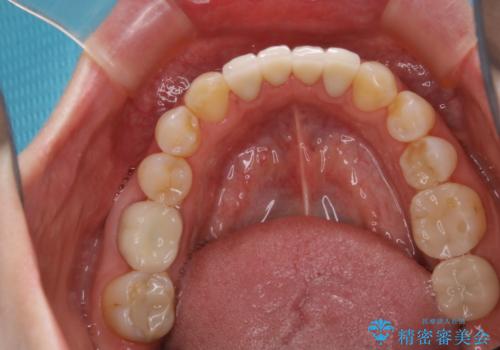インプラントの2次手術前にPMTCで清潔な口腔内にの治療前