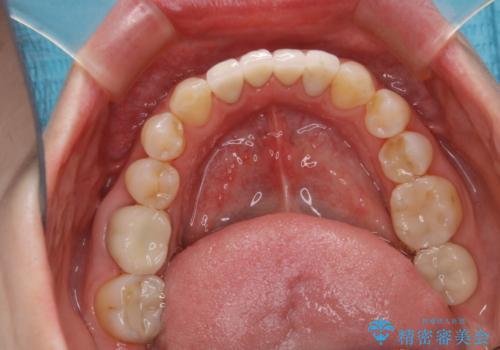 インプラントの2次手術前にPMTCで清潔な口腔内にの治療後