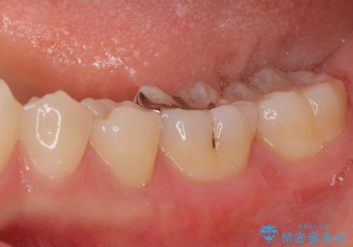 セラミックとゴールド　奥歯のむし歯治療の治療前