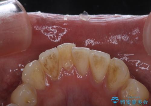 タバコによる着色をPMTCできれいな白い歯にの治療前