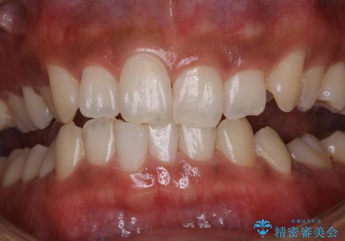 タバコによる着色をPMTCできれいな白い歯にの治療後
