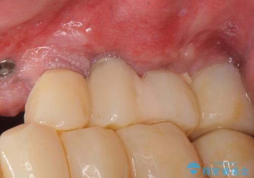 歯肉移植(FGG)による角化歯肉の獲得で長持ちするインプラントへ　50代男性の治療前