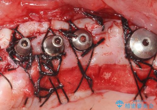 歯肉移植(FGG)による角化歯肉の獲得で長持ちするインプラントへ　50代男性の治療中