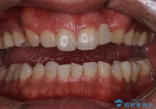 前歯のステインを取りたい　PMTCできれいにの治療前