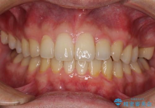 前歯のクロスバイトと抜歯が必要な奥歯の虫歯　インビザラインとインプラント治療の治療中