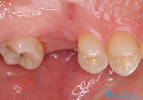 前歯のクロスバイトと抜歯が必要な奥歯の虫歯　インビザラインとインプラント治療の治療前