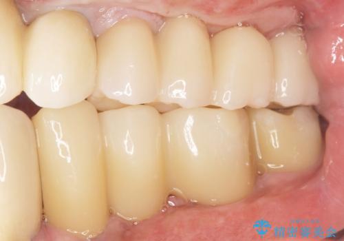歯肉移植(FGG)による角化歯肉の獲得で長持ちするインプラントへ　50代男性の治療後