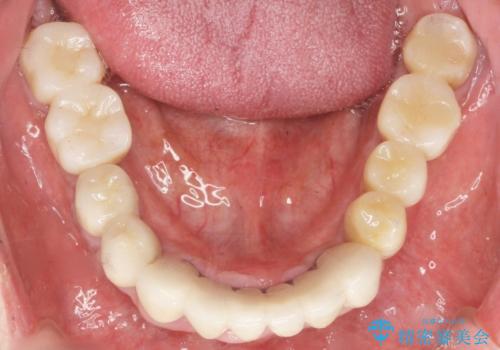 歯がぐらぐらで咬めない　奥歯のインプラント　50代男性の治療後