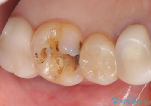 銀歯の下が虫歯になっている　セラミックインレー　30代女性の治療前