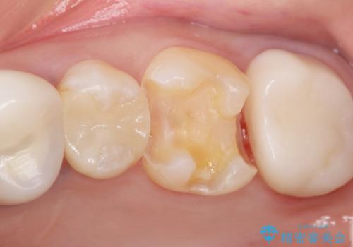 銀歯の下が虫歯になっている　セラミックインレー　30代女性の治療中