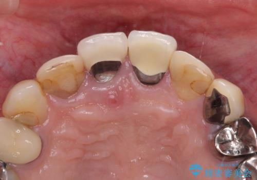 鼻の下を押すと痛い　抜歯を避けてきた歯を抜歯して自然な口元にの治療前