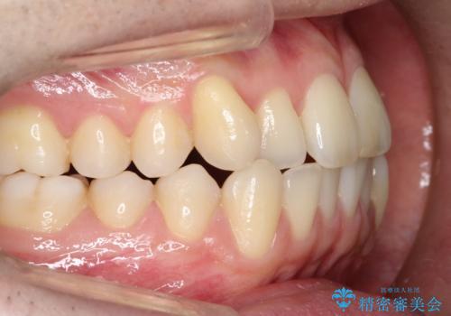 【クリア装置】前歯の凸凹を綺麗にしたいの治療前