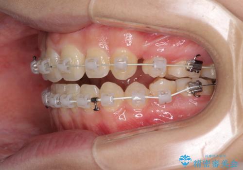話しにくいオープンバイト　ワイヤー装置による抜歯矯正治療の治療中