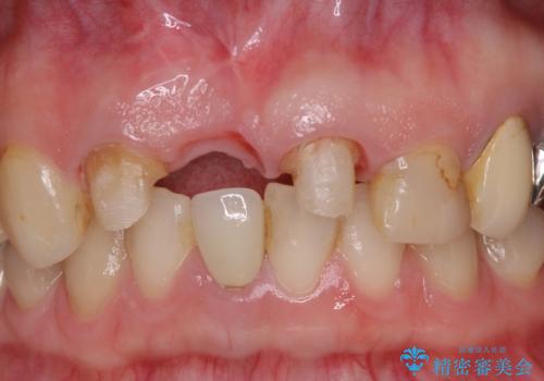 鼻の下を押すと痛い　抜歯を避けてきた歯を抜歯して自然な口元にの治療中